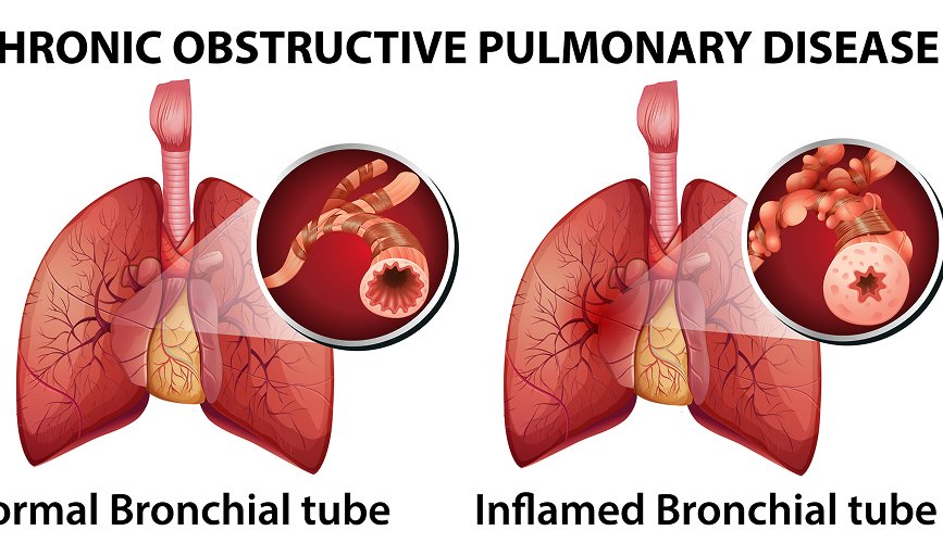 Abscess Drainage