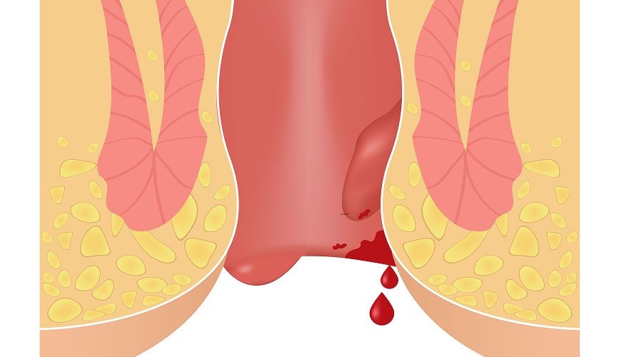Anal Fissure Treatment