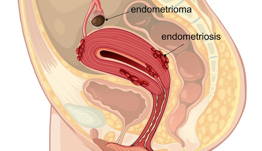 Anal Fistula Treatment