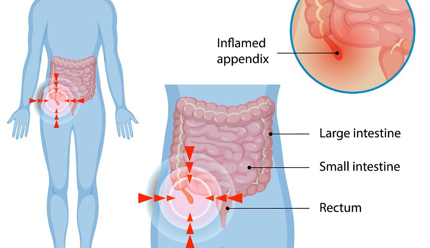 Appendicitis Treatment
