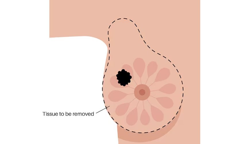 Breast Cancer Surgery