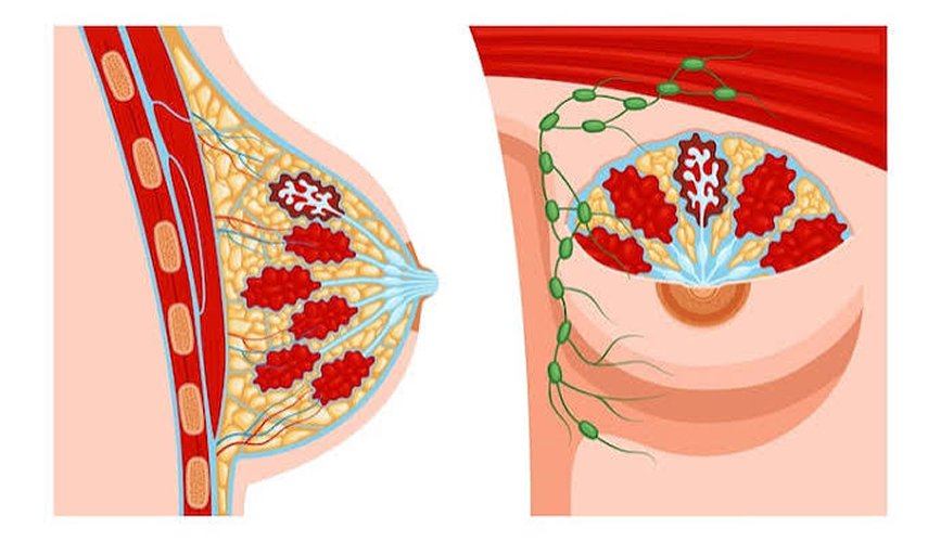 Breast Lump Evaluation & Treatment