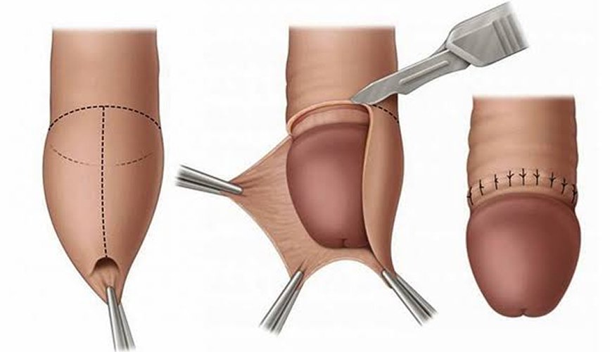 Circumcision