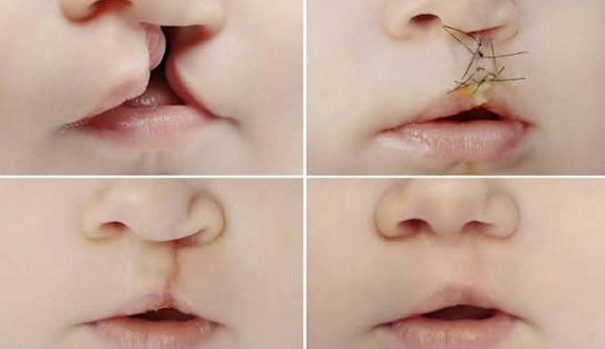 Congenital Anomaly Surgery
