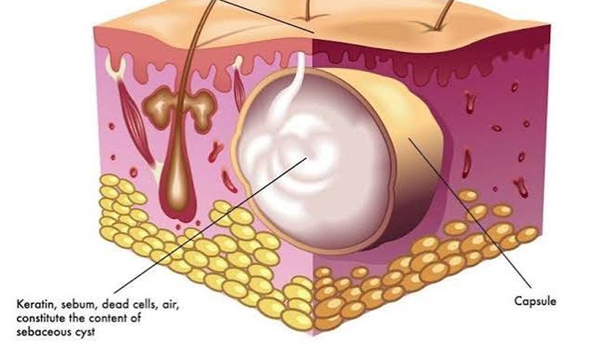 Cyst Removal