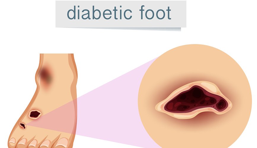 Diabetic Foot Treatment & Surgery