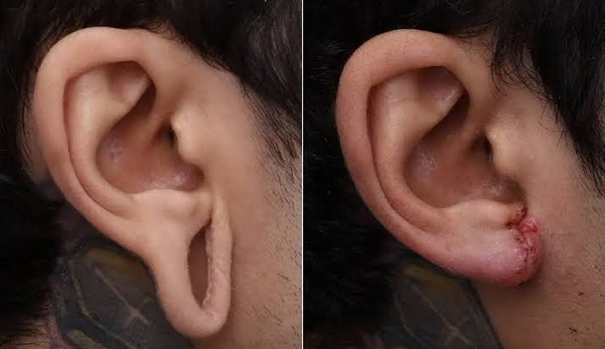 Ear Lobe Repair
