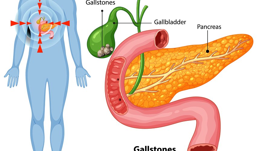 Gallstones Treatment
