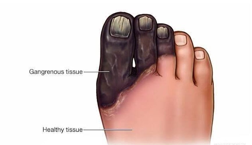 Gangrene Treatment & Surgery