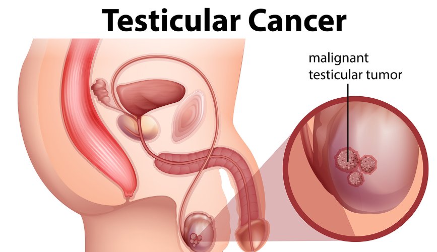 Hydrocele Surgery