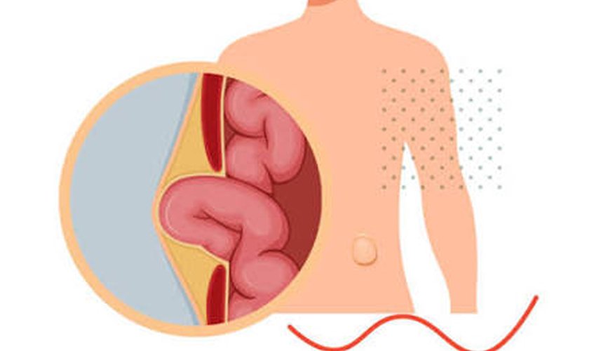 Incisional Hernia Treatment