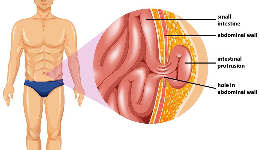 Inguinal Hernia Treatment