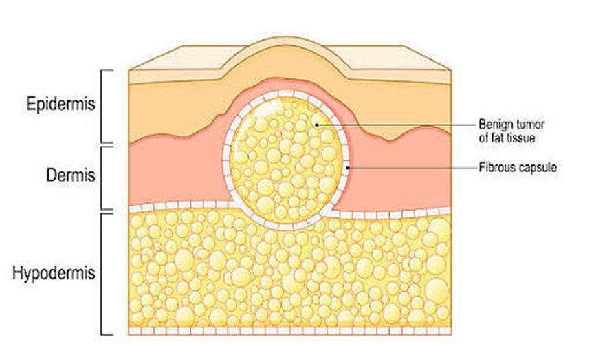 Lipoma (Fatty Lump) Removal