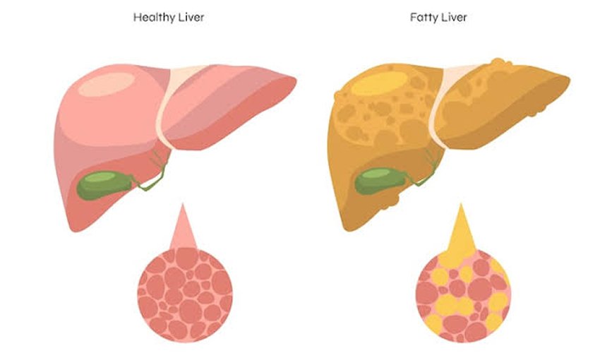 Liver Abscess Drainage