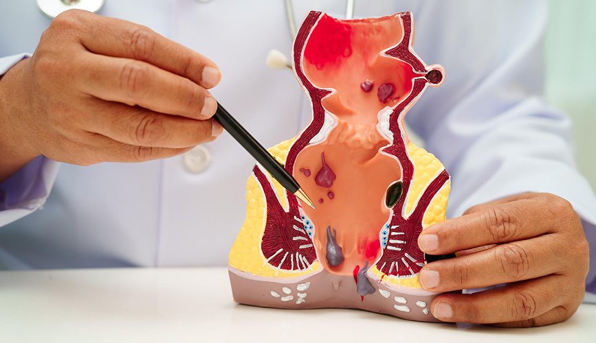 Piles (Hemorrhoids) Treatment