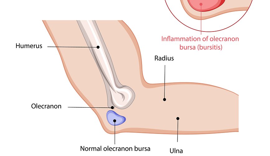 Soft Tissue Lump Treatment