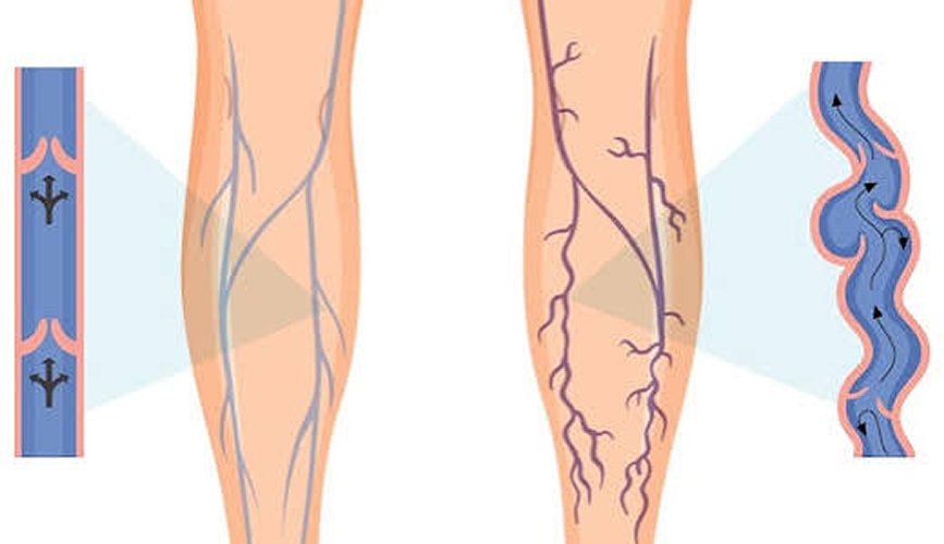 Varicose Vein Surgery